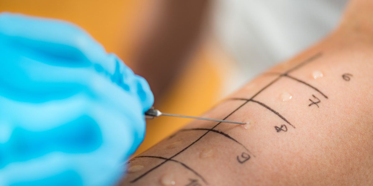 testarea cutanată în diagnosticul alergiilor